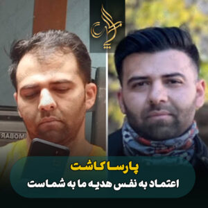 نمونه کار کاشت مو شیراز کلینیک پارسامهر