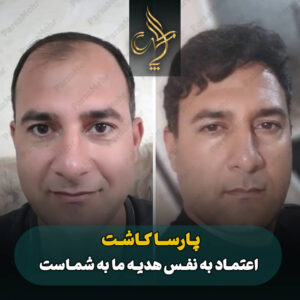نمونه کار کاشت مو شیراز کلینیک پارسامهر