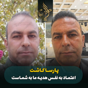 نمونه کار کاشت مو شیراز کلینیک پارسامهر