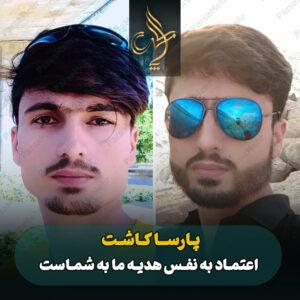 نمونه کار کاشت مو شیراز کلینیک پارسامهر