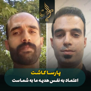 نمونه کار کاشت مو شیراز کلینیک پارسامهر