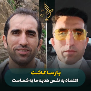 نمونه کار کاشت مو شیراز کلینیک پارسامهر
