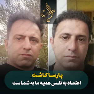 نمونه کار کاشت مو شیراز کلینیک پارسامهر