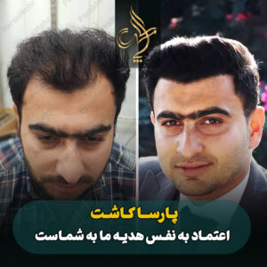 نمونه کار کاشت مو شیراز کلینیک پارسامهر