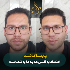 نمونه کار کاشت مو شیراز کلینیک پارسامهر