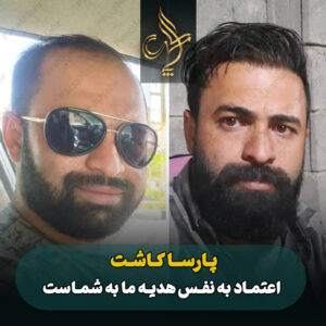 نمونه کار کاشت مو شیراز کلینیک پارسامهر