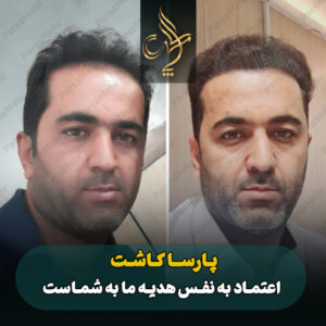 نمونه کار کاشت مو شیراز کلینیک پارسامهر