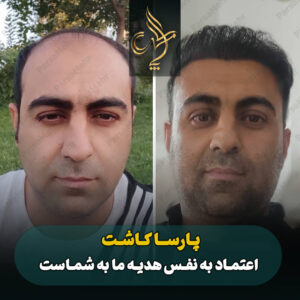 نمونه کار کاشت مو شیراز کلینیک پارسامهر