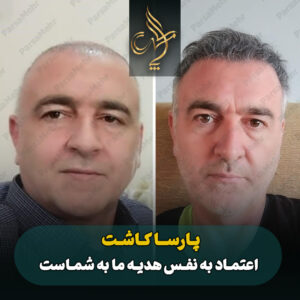 نمونه کار کاشت مو شیراز کلینیک پارسامهر