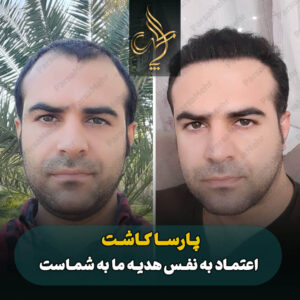 نمونه کار کاشت مو شیراز کلینیک پارسامهر
