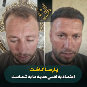نمونه کار کاشت مو شیراز کلینیک پارسامهر