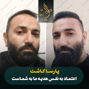 نمونه کار کاشت مو شیراز کلینیک پارسامهر