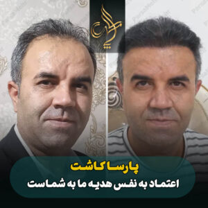 نمونه کار کاشت مو شیراز کلینیک پارسامهر