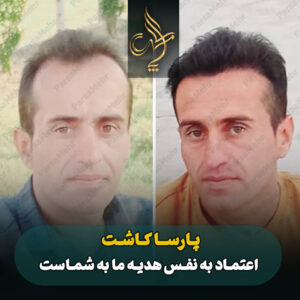 نمونه کار کاشت مو شیراز کلینیک پارسامهر