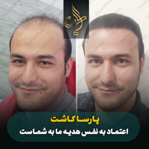 نمونه کار کاشت مو شیراز کلینیک پارسامهر