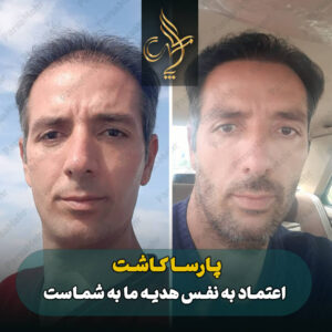 نمونه کار کاشت مو شیراز کلینیک پارسامهر