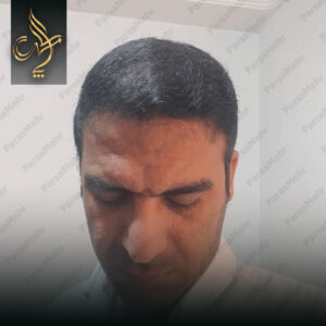 نمونه کار کاشت مو شیراز کلینیک پارسامهر