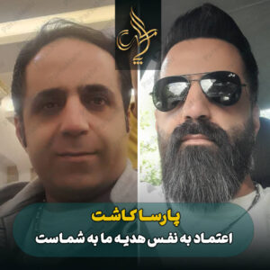 نمونه کار کاشت مو شیراز کلینیک پارسامهر