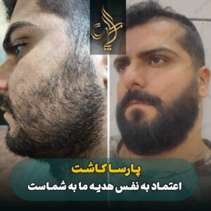 نمونه کار کاشت مو شیراز کلینیک پارسامهر