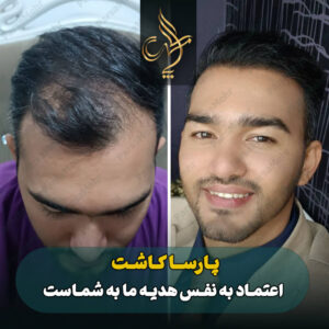 نمونه کار کاشت مو شیراز کلینیک پارسامهر