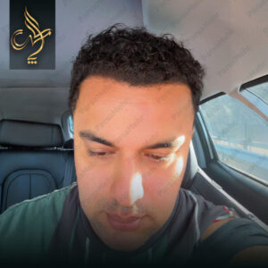 نمونه کار کاشت مو شیراز کلینیک پارسامهر