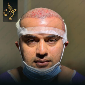 نمونه کار کاشت مو شیراز کلینیک پارسامهر