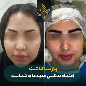 نمونه کار کاشت ابرو شیراز کلینیک پارسامهر