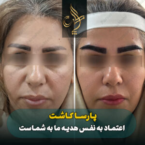 نمونه کار کاشت ابرو شیراز کلینیک پارسامهر