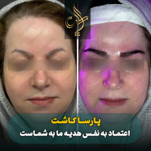 نمونه کار کاشت ابرو شیراز کلینیک پارسامهر