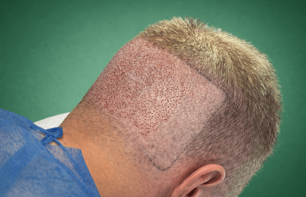 زراعة الشعر بتقنية FIT